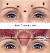 Botox-Inject