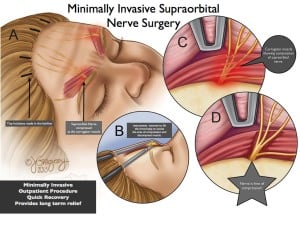 minimally invasive supraorbital nerve surgery